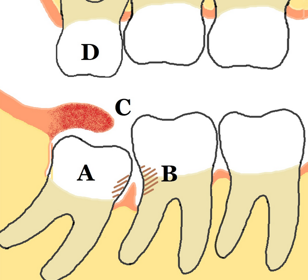 dental-implants-and-wisdom-teeth-removal-costs-dental-costs-australia