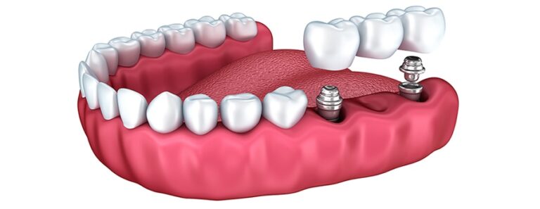 Dental Implant cost in Thailand