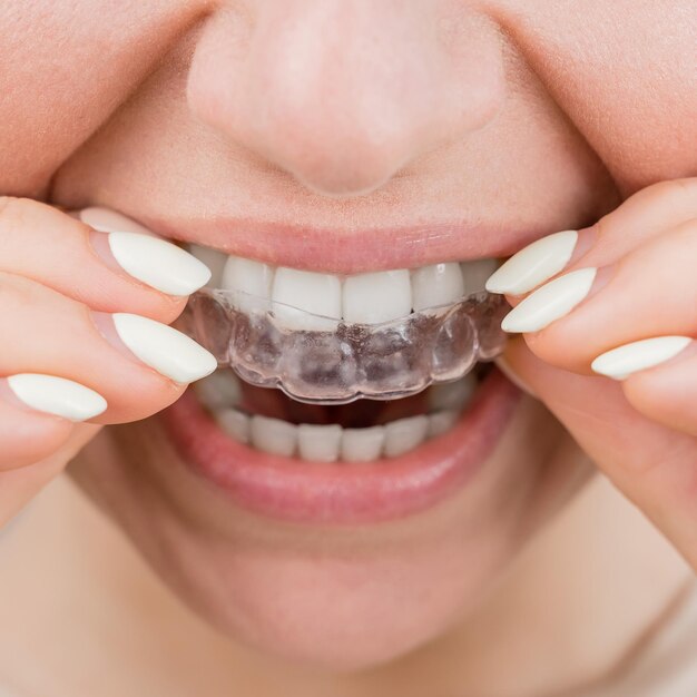 Cost of invisible braces in Australia - Dentistscost