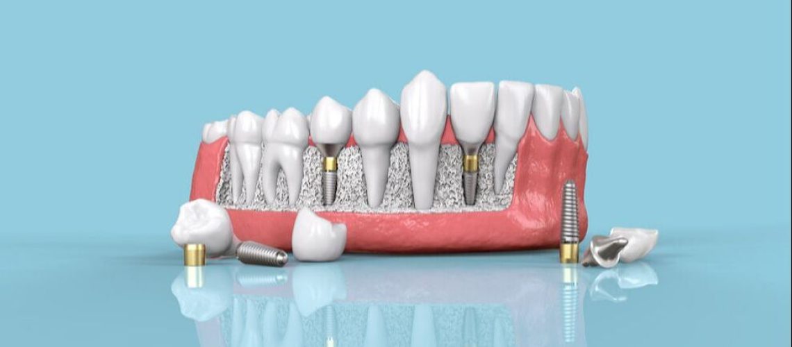 The Dental Implants Cost Is Now Affordable Now - Know How!