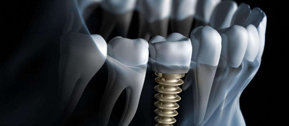 Everything You Need To Know About Dental Implant Cost
