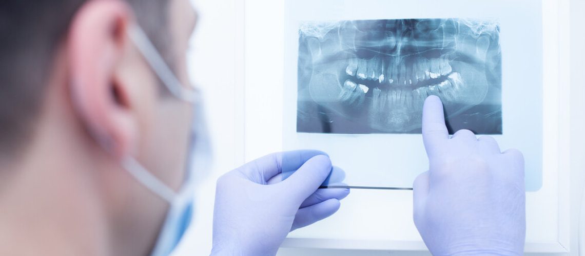 Facts about Wisdom Teeth Removal Cost