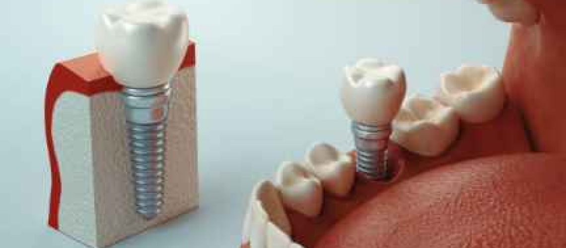 cheap dental implants Australia