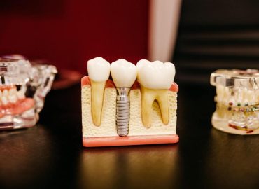 Dental Implant Cost Australia
