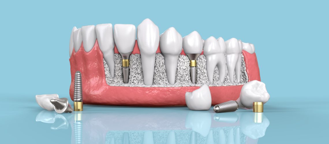 dental implants Australia - dental costs australia