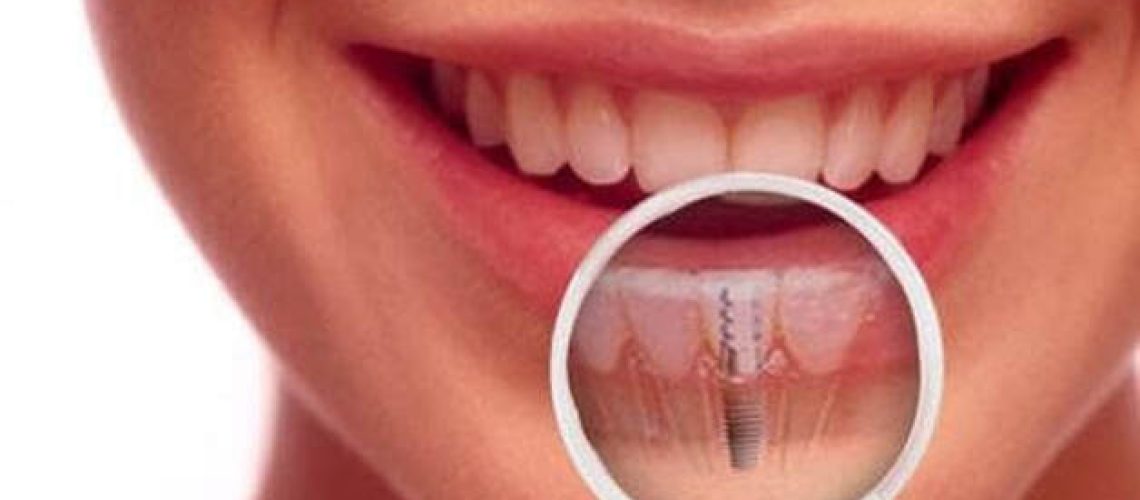 Dental Implants Aftercare and Maintenance