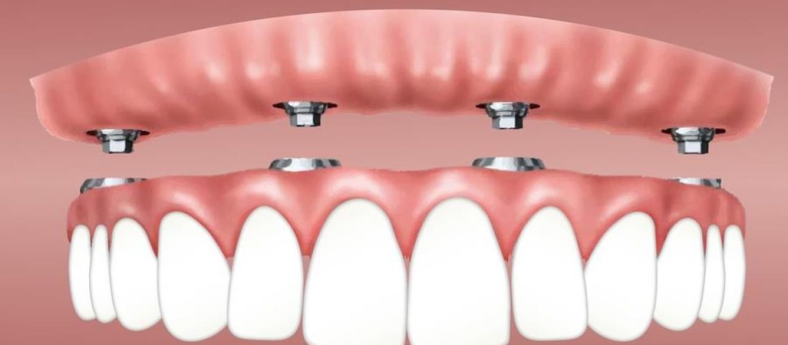 dental implants cost in Australia.