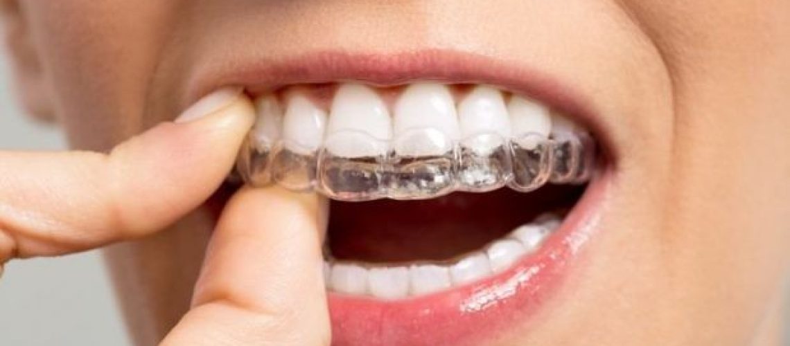 Everything You Need to Know About Invisible Braces