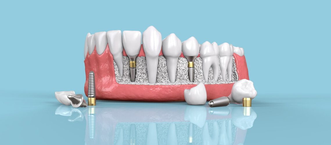 A Guide to Dental Implant Cost