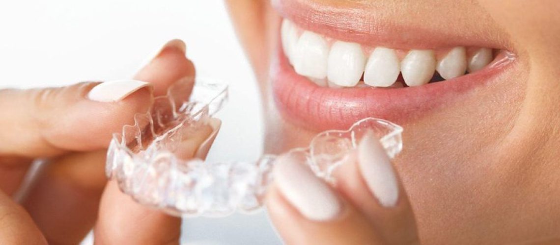 Invisible Braces vs. Traditional Braces - few benefits for Adult Patients Requiring Orthodontics
