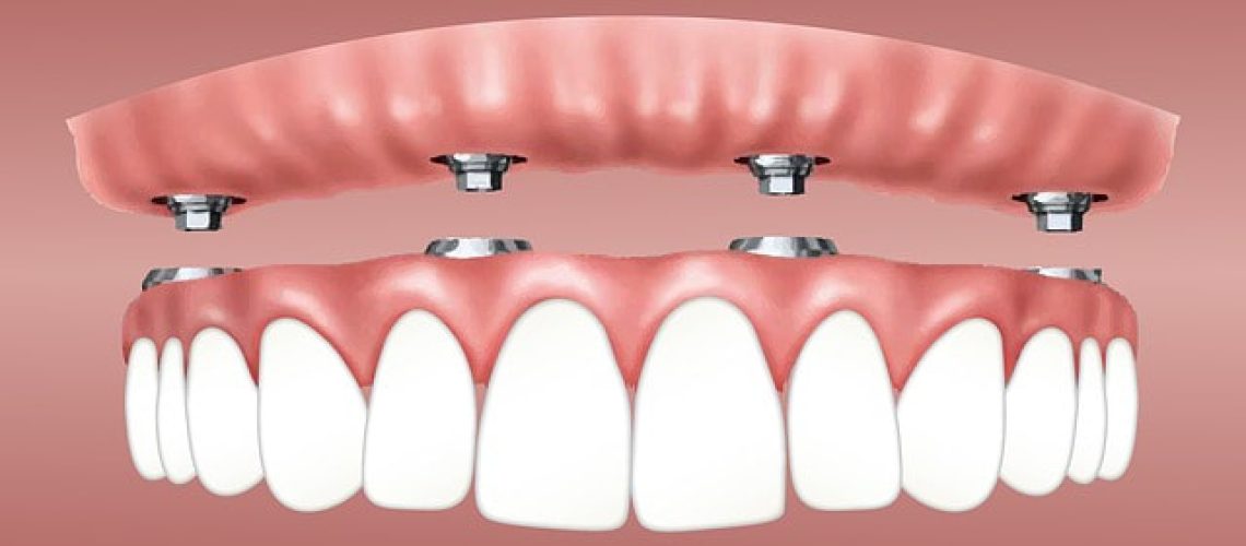 Why should you look into Dental Implants?
