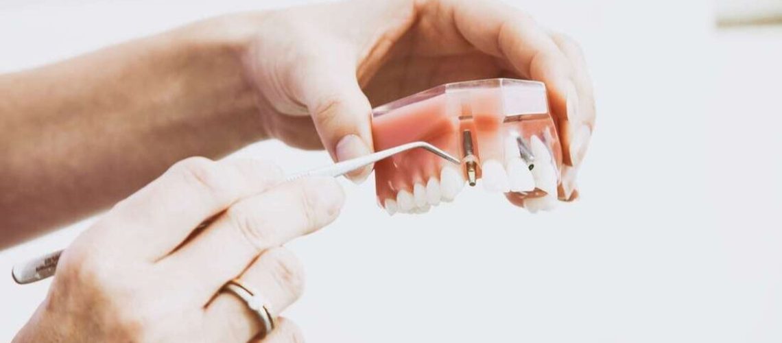 Dental Implants Sydney should you get one?